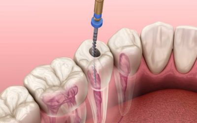 Root canal treatment in Liverpool, Merseyside